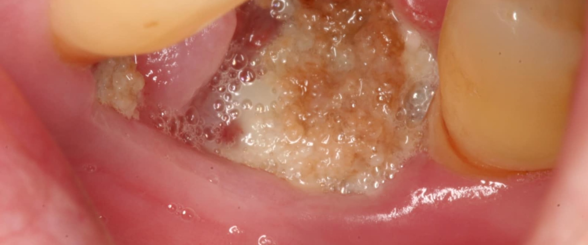 Can An Infected Tooth Cause Other Issues