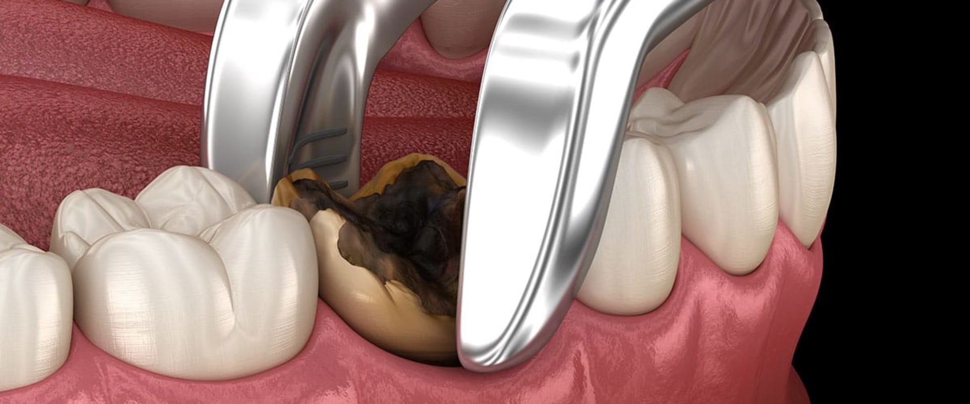 how-long-does-the-pain-last-after-tooth-extraction