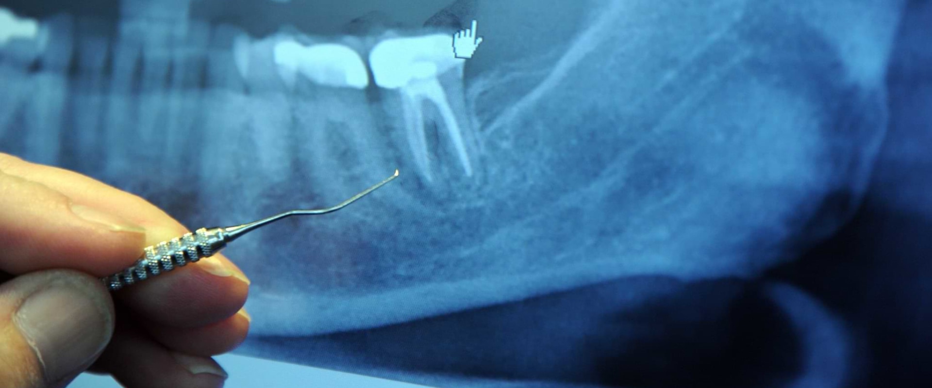 root-canal-vs-tooth-extraction-what-s-the-difference