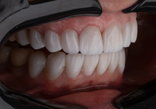 Understanding The Necessity Of Tooth Extraction Before Dental Implants In Manassas, VA
