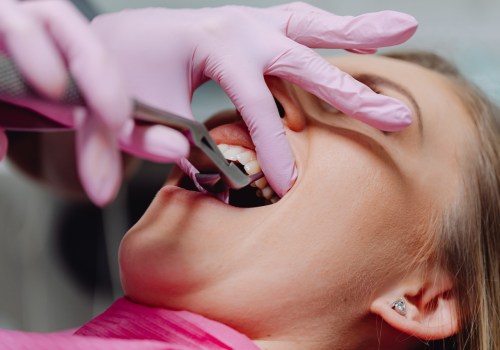Beyond Dentistry: The Role Of Holistic Health Coaching In Sydney's Tooth Extraction Journey